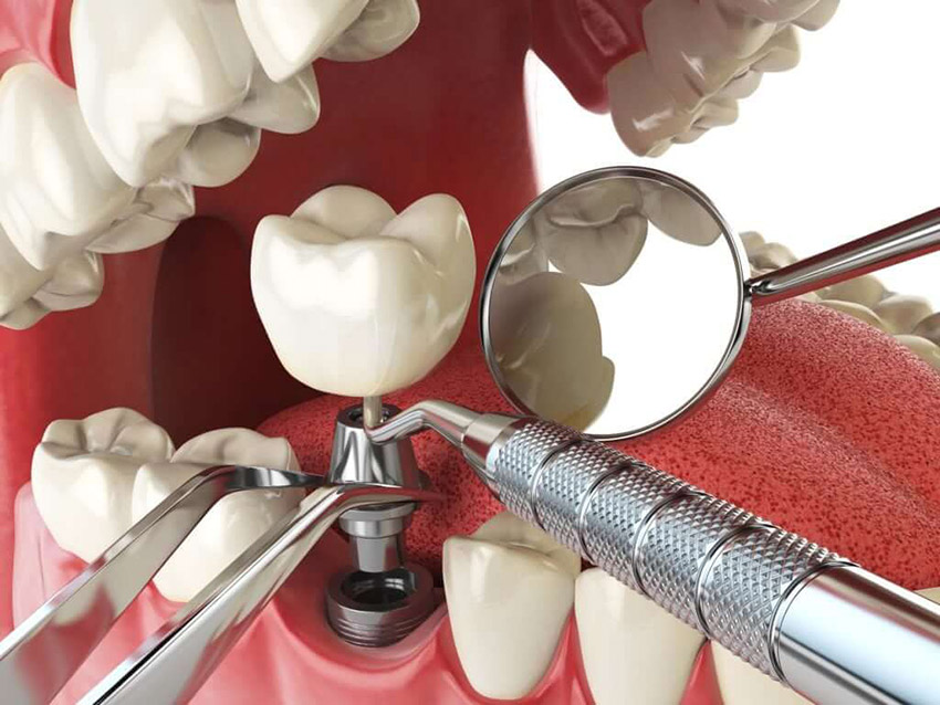 درمان ایمپلنت دندان 
