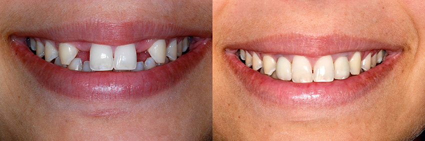 نمونه‌ای از درمان ایمپلنت دندان