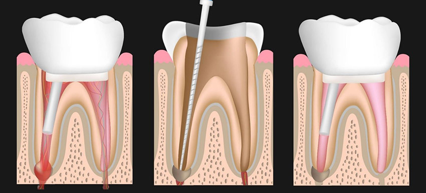 روند درمانی کانال ریشه دندان و عصب کشی