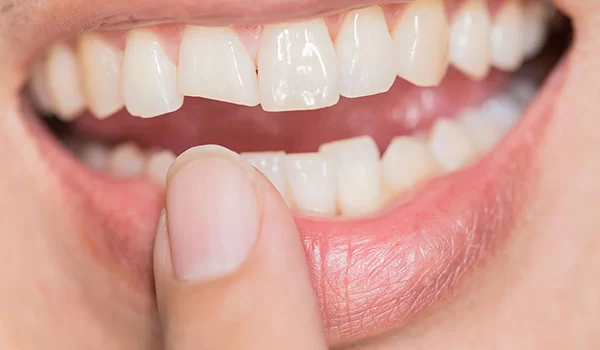  باندینگ دندان
