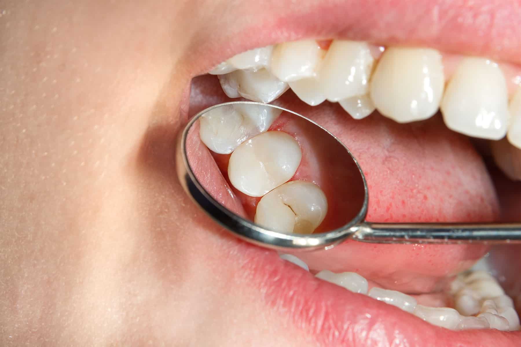 مزایای ترمیم دندان