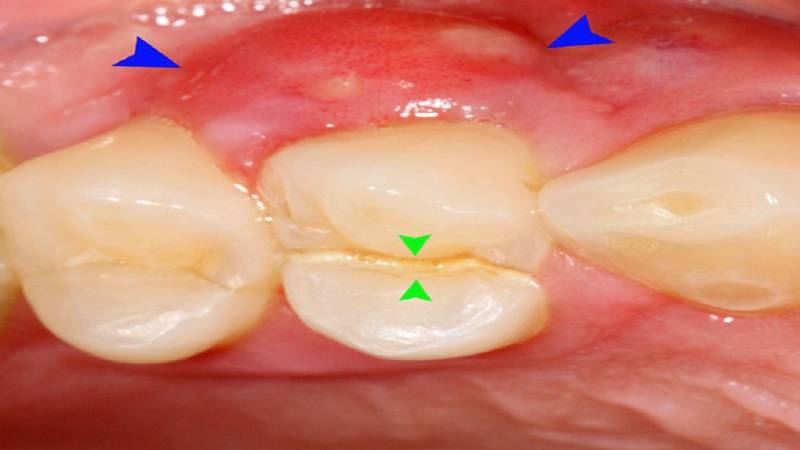آبسه دندان