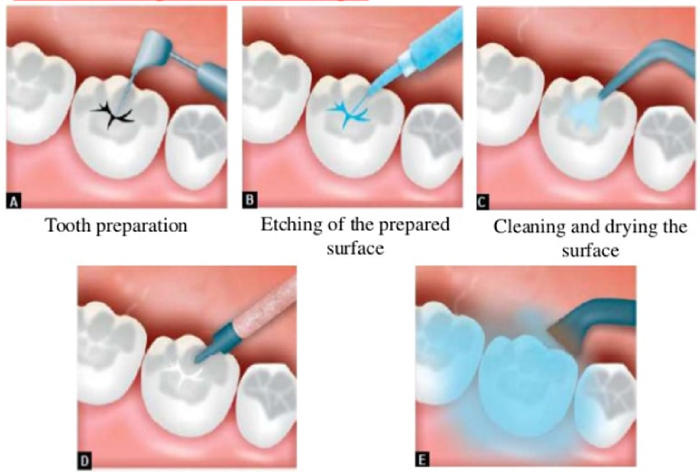 مراحل پر کردن دندان با کامپوزیت