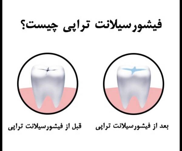 فیشور سیلانت دندان