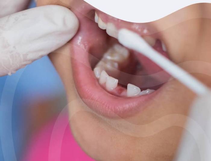 فلوراید تراپی دندان