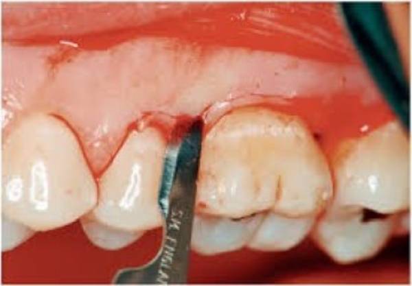 درمان کیست دندان