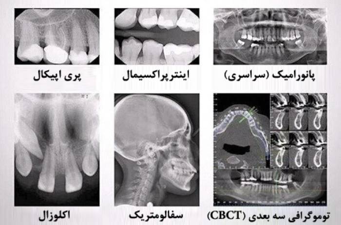 انواع رادیوگرافی دندان
