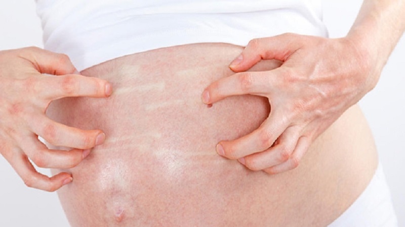 خشکی پوست در بارداری