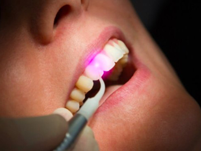 کاربرد لیزر در دندان پزشکی