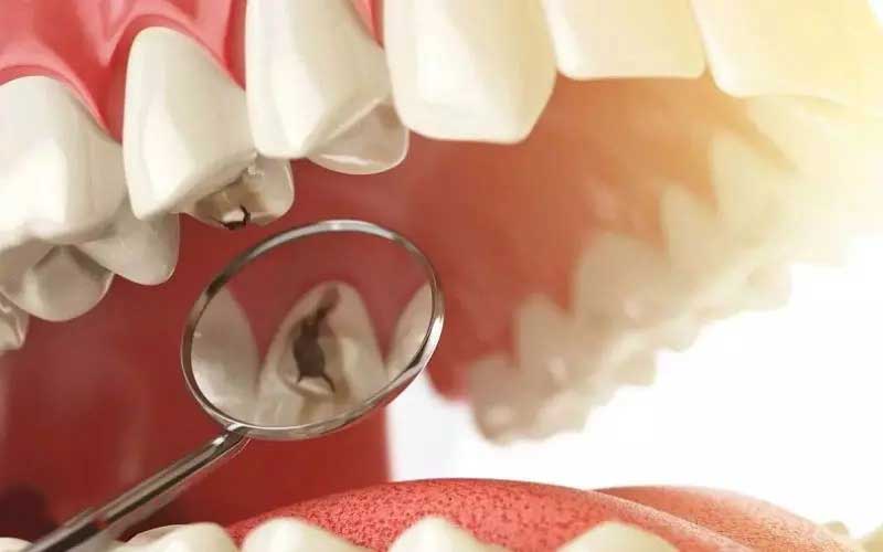 لمینت دندان و پوسیدگی دندان