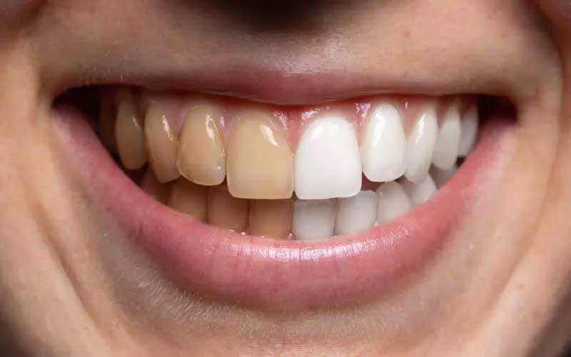 لمینت دندان برای افراد سیگاری