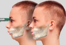 جراحی فک برای اصلاح ناهنجاری های مادرزادی