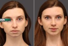 جراحی چانه برای زیبایی صورت؛ روش ها و نتایج