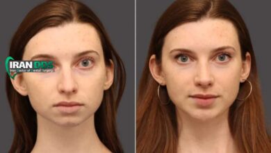جراحی چانه برای زیبایی صورت؛ روش ها و نتایج