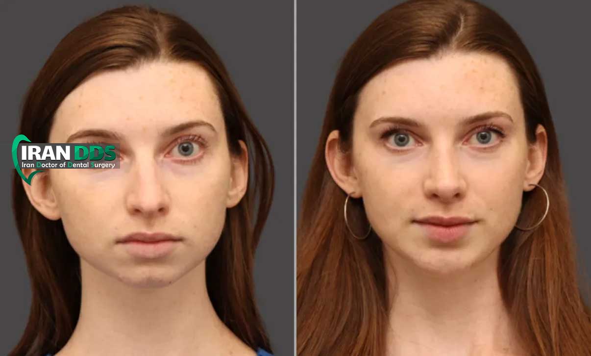 جراحی چانه برای زیبایی صورت؛ روش ها و نتایج