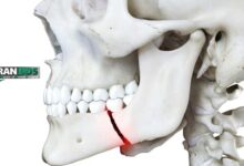 هر آنچه باید درباره درمان شکستگی فک بدانید (علائم، مراحل و مدت بهبودی)