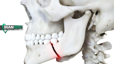هر آنچه باید درباره درمان شکستگی فک بدانید (علائم، مراحل و مدت بهبودی)