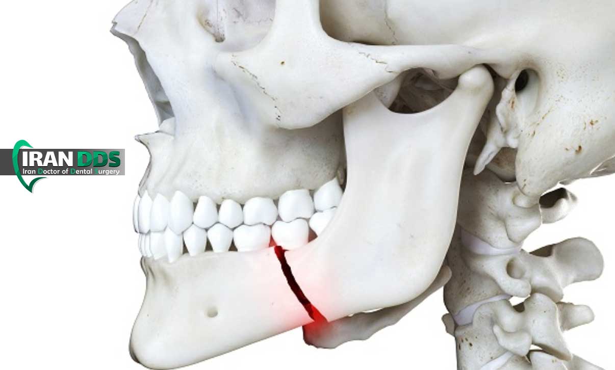 هر آنچه باید درباره درمان شکستگی فک بدانید (علائم، مراحل و مدت بهبودی)