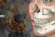 بهترین تغذیه بعد جراحی فک و دندان چیست؟ راهنمای کامل رژیم غذایی نرم و مقوی