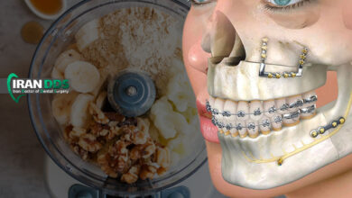 بهترین تغذیه بعد جراحی فک و دندان چیست؟ راهنمای کامل رژیم غذایی نرم و مقوی