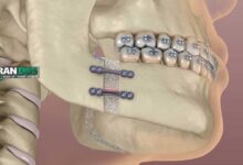 هزینه جراحی فک در سال ۱۴۰۴ چقدر است؟ بررسی عوامل موثر بر قیمت و راههای کاهش هزینه