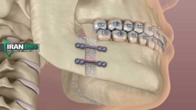 هزینه جراحی فک در سال ۱۴۰۴ چقدر است؟ بررسی عوامل موثر بر قیمت و راههای کاهش هزینه