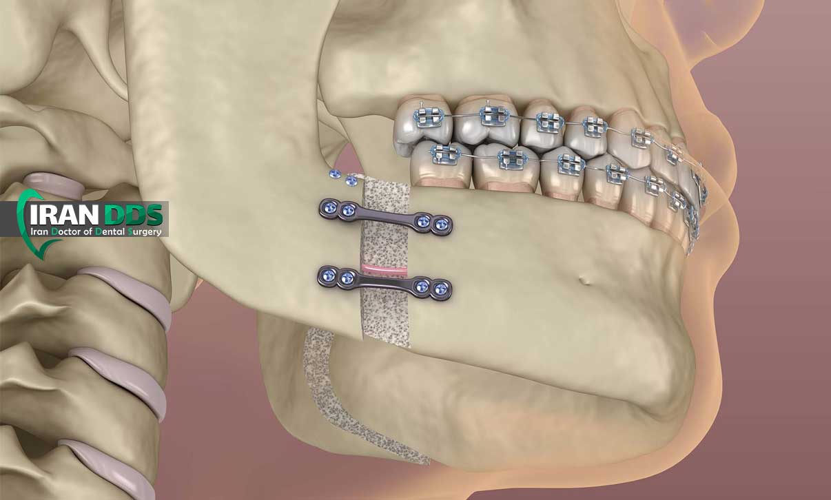 هزینه جراحی فک در سال ۱۴۰۴ چقدر است؟ بررسی عوامل موثر بر قیمت و راههای کاهش هزینه