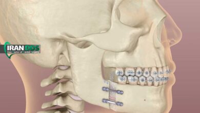 بهترین سن برای جراحی فک و ارتوگناتیک از نظر پزشکان؛ چه سنی بیشترین نتیجه را دارد؟