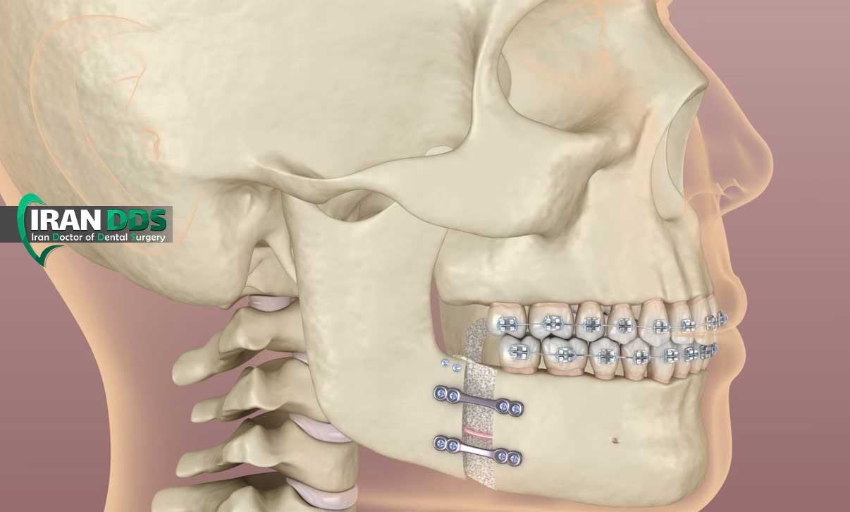 بهترین سن برای جراحی فک و ارتوگناتیک از نظر پزشکان؛ چه سنی بیشترین نتیجه را دارد؟